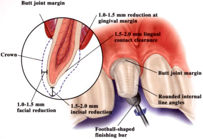 empress-anterior-crown